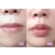 Hyaluronic Acid Based Dermal Filler For Lip Enhancement(2ml)